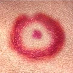 Lyme+Disease+Rash