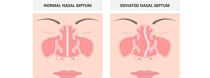 Shutterstock_2136200891-Deviated-Septum-800x300