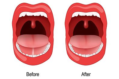 Shutterstock-2173312541-Tongue-Tie-396x264