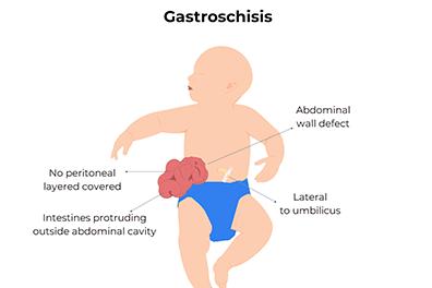 Shuttterstock_2019496274-Gastroschisis-396x264