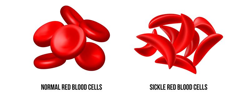 Shutterstock_2194917753-Sickle-Cell-800x300