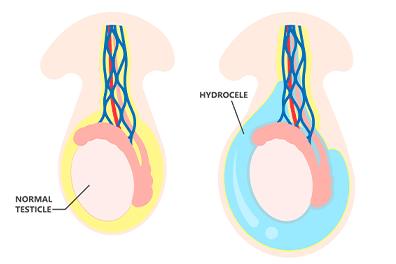 Shutterstock_1861028659_Hydrocele-396x264