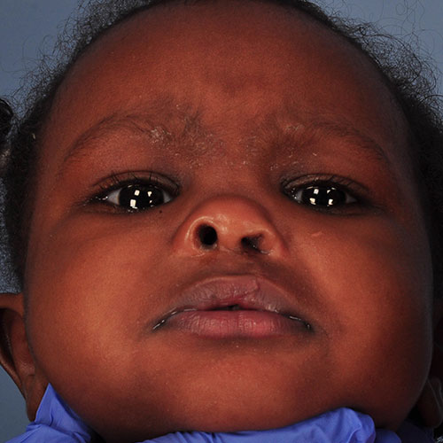 Marib Mohamei DOB 1/11/2017 after Unilateral Cleft Lip and Palate surgery