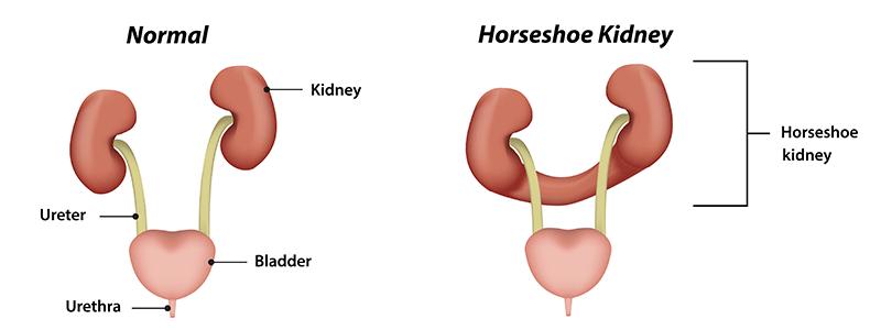 Shutter-Stock_263410100_Horseshoe-Kidney-800x300