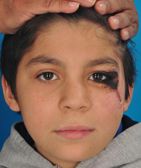 Luis Torres (DOB 4/4/2001) Luis had a substantial nevus (mole) surrounding his eye. Image before treatment. There are 3 additional images used from different angles.