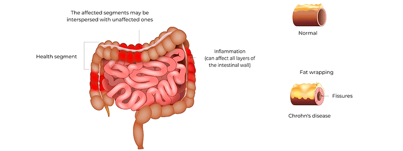 Shutterstock_2441338813_Crohns-Disease-800x300