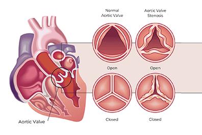Shutterstock_1968954070-Aortic-Stenosis-396x264