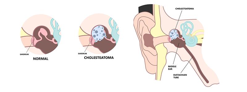 Shutterstock_2162934151-Cholesteatoma-800-x300
