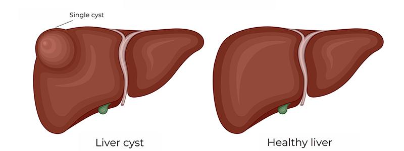Shutterstock-1777342913-Liver-Cyst-800x300