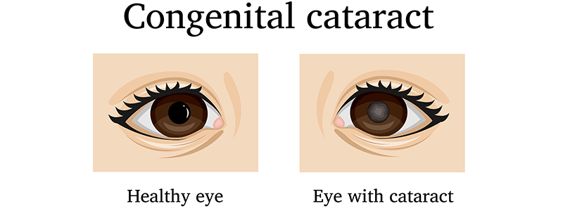 Shutterstock_762875167_Cataracts-800x300