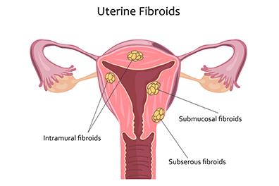 Shutterstock_555102964-Uterine-Fibroids-396x264