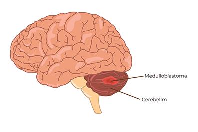 Shutterstock_2418576895-Medulloblastoma-396x264