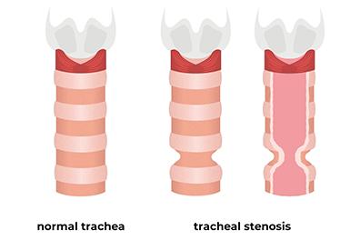 Shutterstock_2340074511-Tracheal-stenosis-396x264