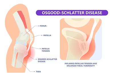 Shutterstock_1990228916-Osgood-Schlatter-Disease-396x264