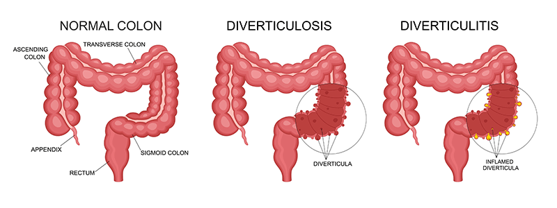 Shutterstock_2229484319_Diverticulitis-800x300