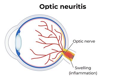 Shutterstock_2215143357-Optic-Neuritis-396x264