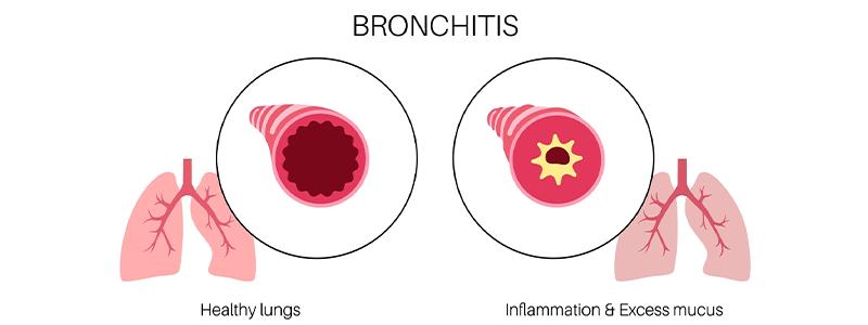 Shutterstock_2286927635-Bronchitis-800x300