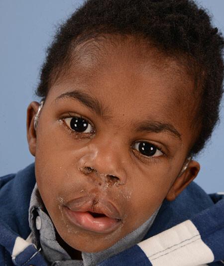 A cleft lip repair elsewhere left Luc with skin covering his upper teeth. Surgical lip revision restored function and appearance. DOB 2/11/2011. 6 additional photos are used at different angles