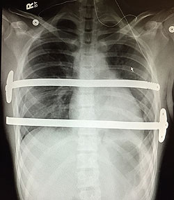 PatientStory_JohnT_1