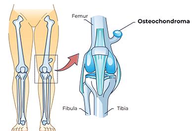 Shutterstock_2161015851-Osteochondroma-396x264