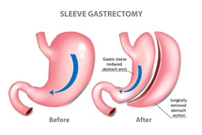 Stockphoto-ID-1135998917---Sleeve-Gastrectomy-396x264